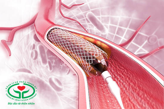Vôi hóa mạch vành cũng có thể được điều trị bằng cách nong mạch, đặt stent