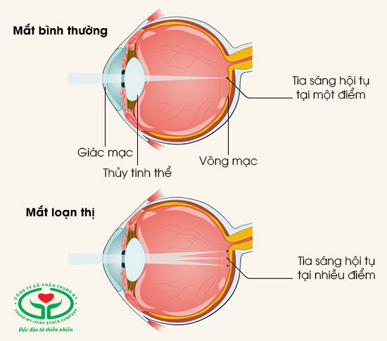 Hình ảnh của mắt bình thường và mắt bị loạn thị
