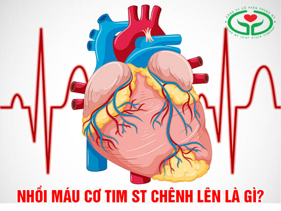 Nhồi máu cơ tim ST chênh lên là gì?